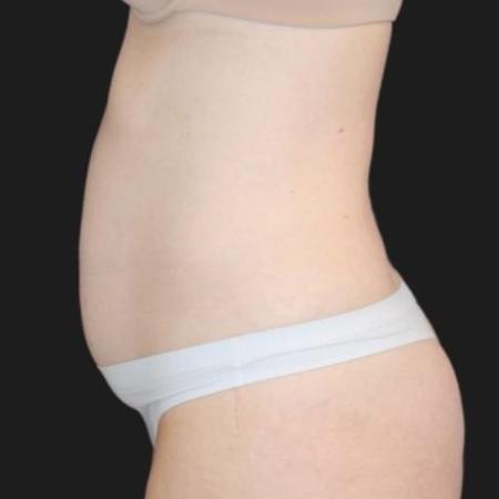 Before image 4 Case #116281 - 41 year old patient | Tummy Tuck