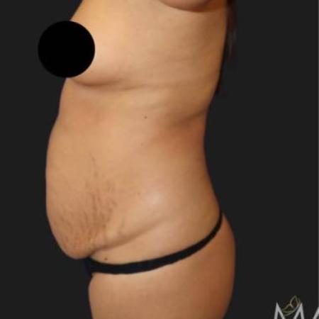 Before image 2 Case #116301 - 44 year old patient | Tummy Tuck