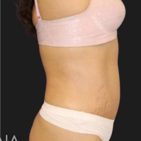 After image 3 Case #116301 - 44 year old patient | Tummy Tuck