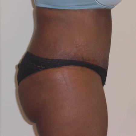After image 3 Case #116416 - Abdominoplasty and Hernia Repair