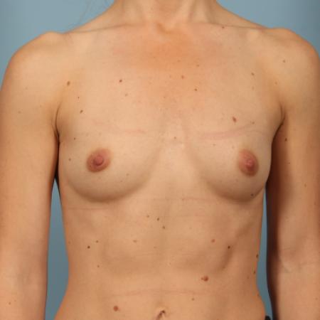 Before image 1 Case #116336 - Breast Augmentation