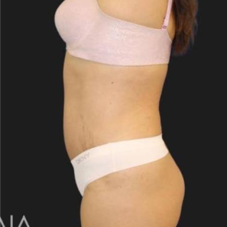 After image 2 Case #116301 - 44 year old patient | Tummy Tuck