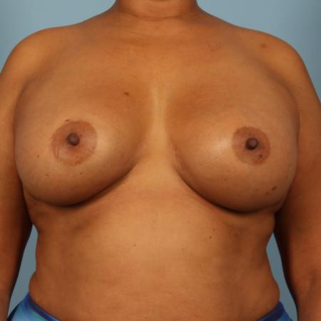 After image 1 Case #116376 - Breast Augmentation