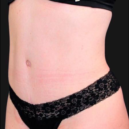 After Case #116306 - 32 year old patient | Tummy Tuck