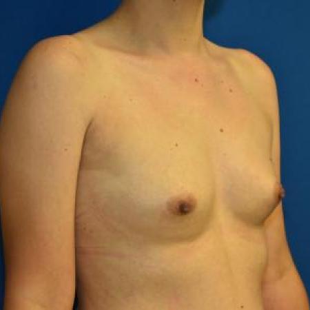 Before image 2 Case #116101 - Breast Augmentation