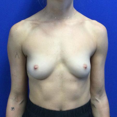 Before image 1 Case #116176 - Breast Augmentation
