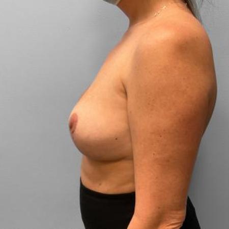 After image 3 Case #116051 - Breast Lift & Implant Removal
