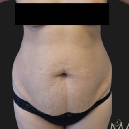 Before image 1 Case #116301 - 44 year old patient | Tummy Tuck
