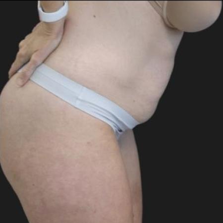 Before image 2 Case #116281 - 41 year old patient | Tummy Tuck