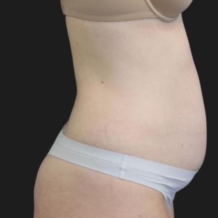 Before image 3 Case #116281 - 41 year old patient | Tummy Tuck