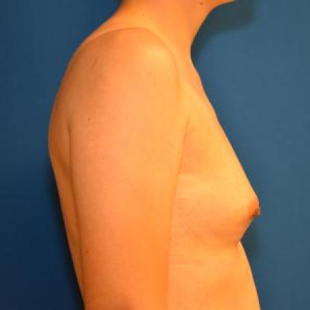 Before image 3 Case #116101 - Breast Augmentation