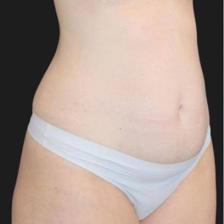 Before image 1 Case #116281 - 41 year old patient | Tummy Tuck