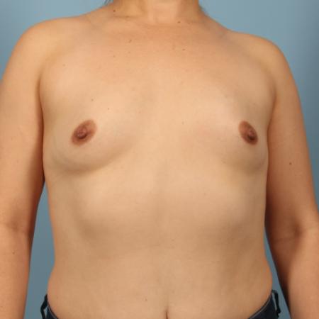Before image 1 Case #116386 - Breast Augmentation