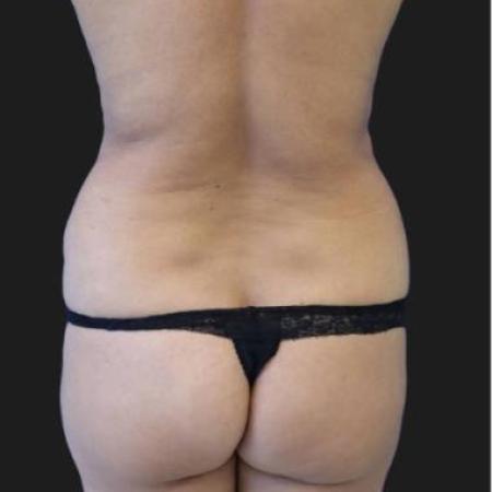 Before image 4 Case #116301 - 44 year old patient | Tummy Tuck