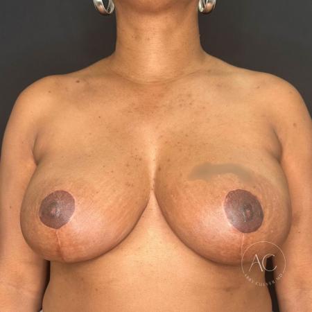 After image 1 Case #116406 - Breast Reduction 