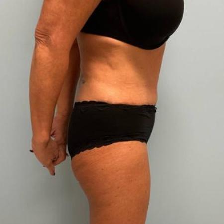 After image 2 Case #112261 - Tummy tuck