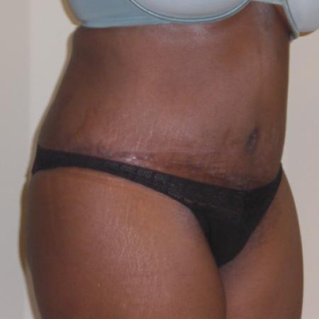 After image 2 Case #116416 - Abdominoplasty and Hernia Repair