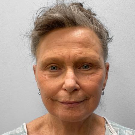 After Case #116881 - Facelift