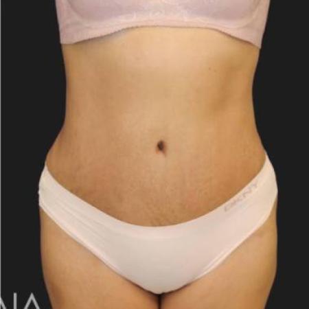 After image 1 Case #116301 - 44 year old patient | Tummy Tuck