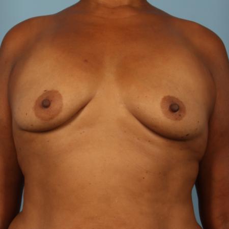 Before image 1 Case #116376 - Breast Augmentation