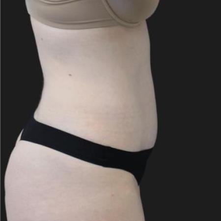 After image 3 Case #116281 - 41 year old patient | Tummy Tuck