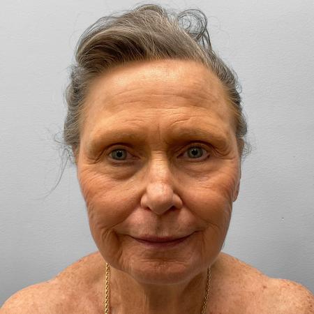 Before Case #116881 - Facelift
