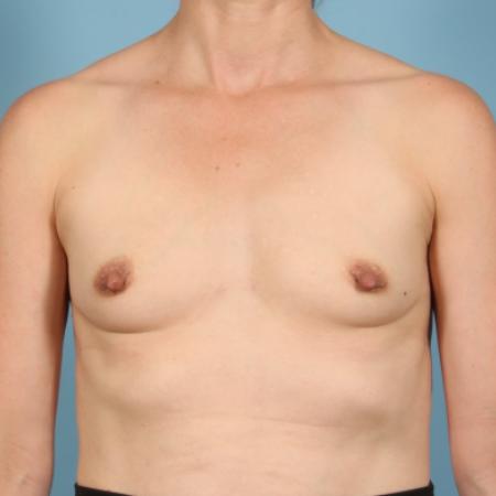 Before image 1 Case #116361 - Breast Augmentation