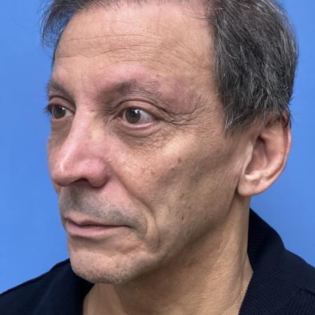Before image 2 Case #117376 - 63 year old Facelift