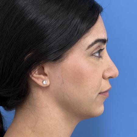 After image 3 Case #117306 - 30 year old - Open Rhinoplasty