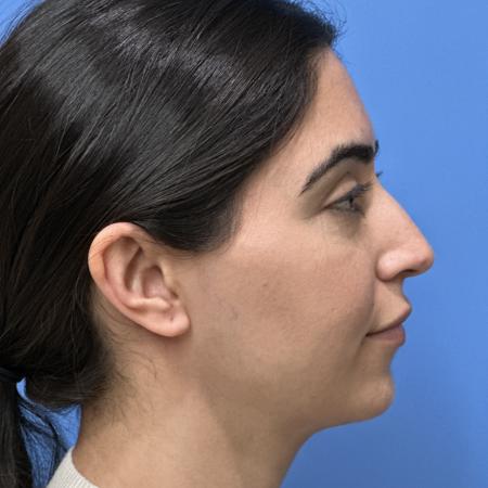 Before image 3 Case #117306 - 30 year old - Open Rhinoplasty