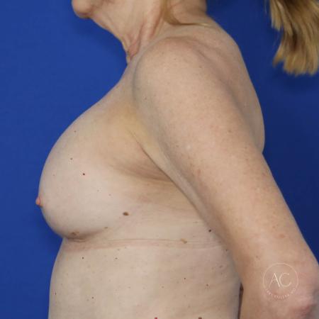 After image 3 Case #115771 - Breast Augmentation with Inverted Nipple Repair