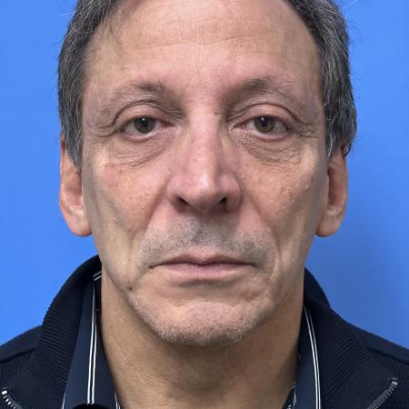 Before image 1 Case #117376 - 63 year old Facelift