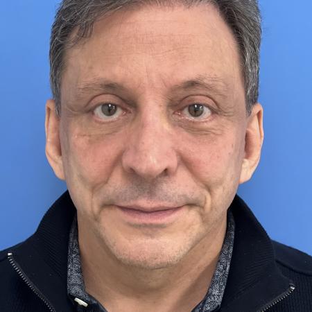 After image 1 Case #117376 - 63 year old Facelift