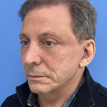 After image 2 Case #117376 - 63 year old Facelift