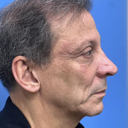 Before image 3 Case #117376 - 63 year old Facelift