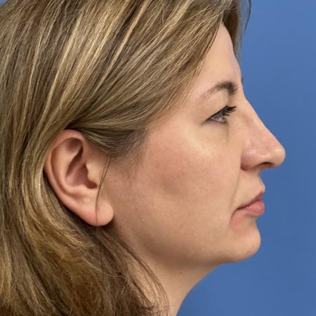 After image 3 Case #117461 - 43 year old  -  Open Rhinoplasty  -  3 months post