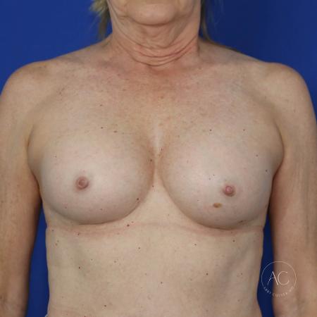 After image 1 Case #115771 - Breast Augmentation with Inverted Nipple Repair