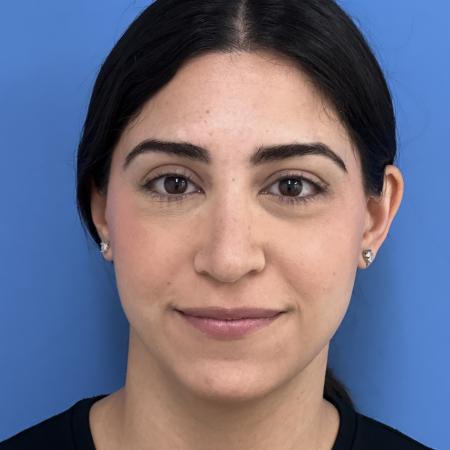 After image 1 Case #117306 - 30 year old - Open Rhinoplasty
