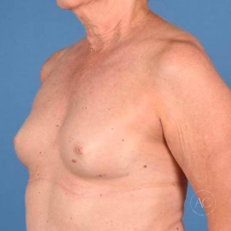 Before image 2 Case #115771 - Breast Augmentation with Inverted Nipple Repair
