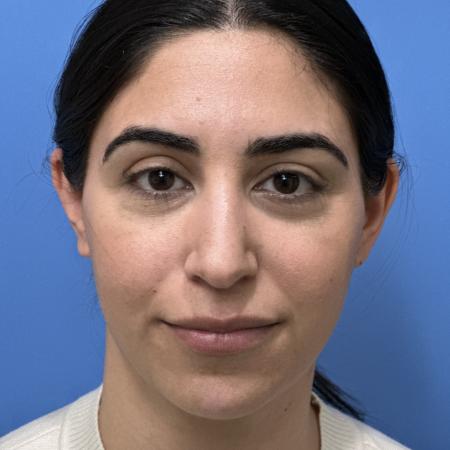 Before image 1 Case #117306 - 30 year old - Open Rhinoplasty