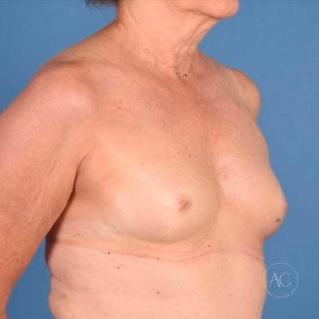 Before image 4 Case #115771 - Breast Augmentation with Inverted Nipple Repair