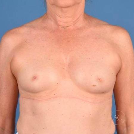 Before image 1 Case #115771 - Breast Augmentation with Inverted Nipple Repair
