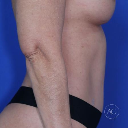 After image 3 Case #117286 - Abdominoplasty with Liposuction