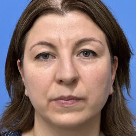 Before image 1 Case #117461 - 43 year old  -  Open Rhinoplasty  -  3 months post