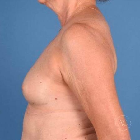 Before image 3 Case #115771 - Breast Augmentation with Inverted Nipple Repair