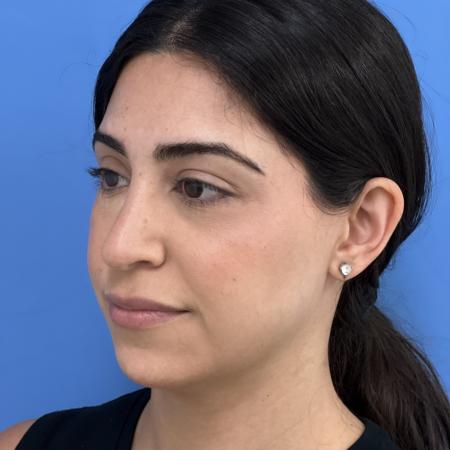 After image 2 Case #117306 - 30 year old - Open Rhinoplasty