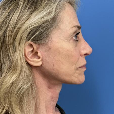 After image 3 Case #118306 - Facelift