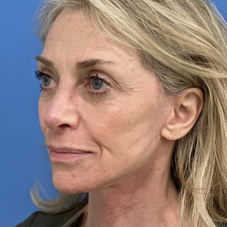After image 2 Case #118306 - Facelift