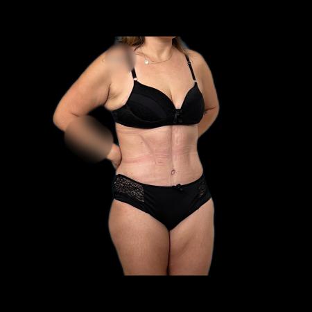 After image 2 Case #118121 - Post-Bariatric Surgery