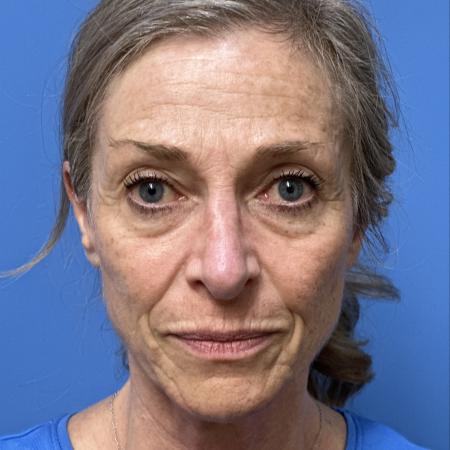 Before image 1 Case #118306 - Facelift
